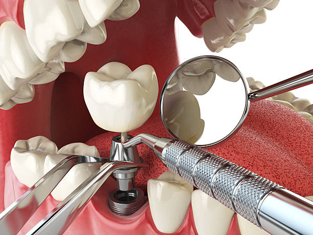 Best Emergency Tooth Extraction in Cedar Knolls, NJ